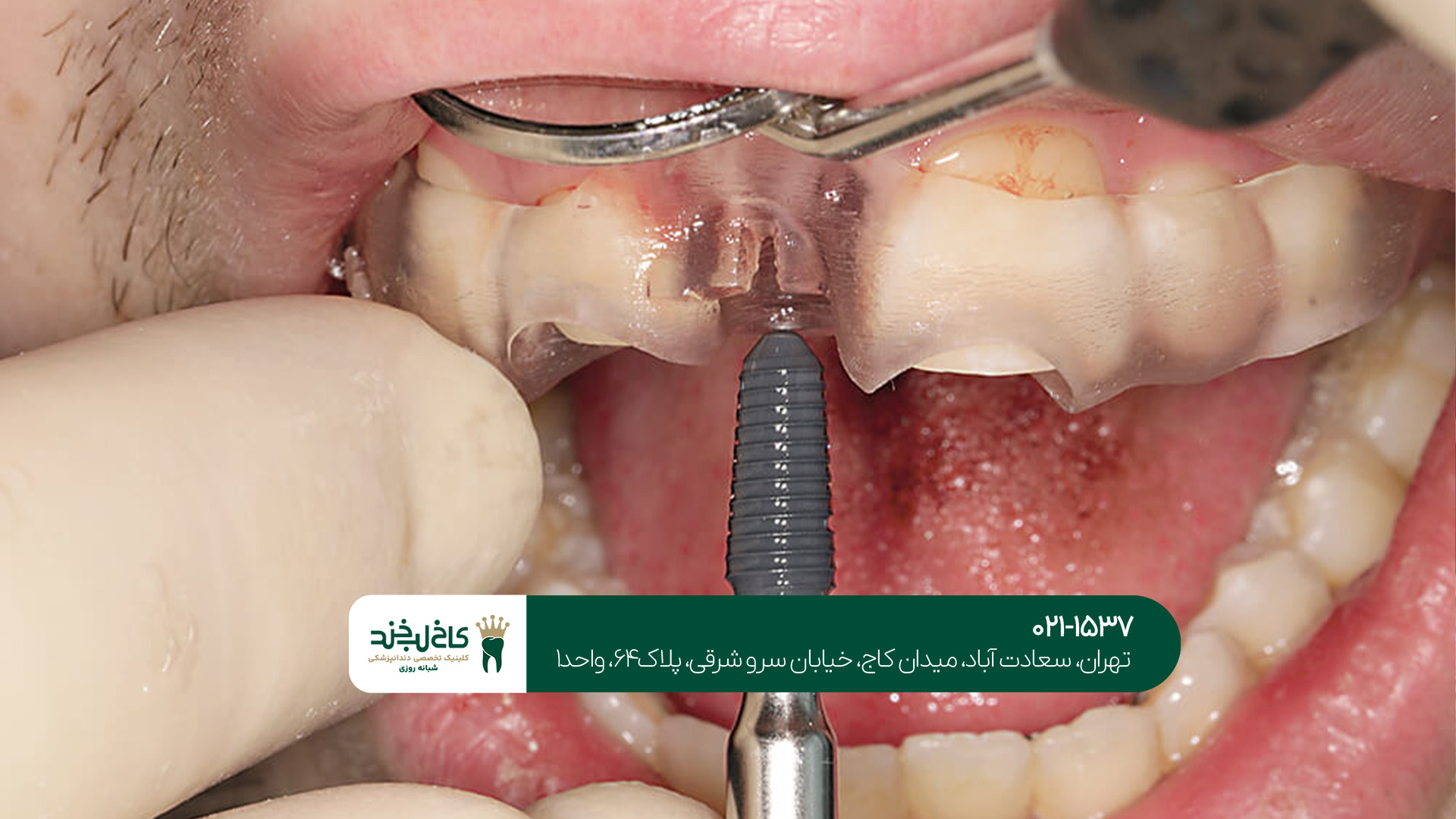 بهترین مرکز ایمپلنت تهران بهترین مرکز ایمپلنت تهران