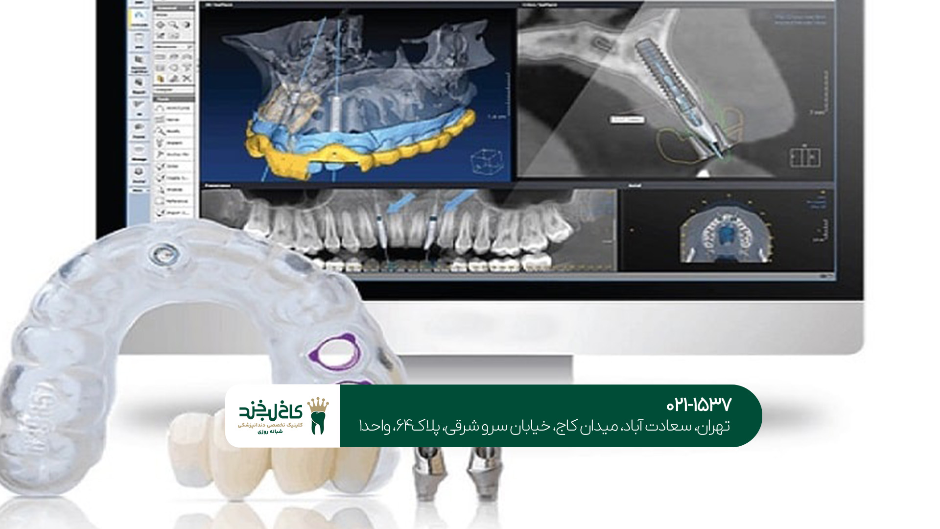 بهترین دندانپزشک ایمپلنت دیجیتال
