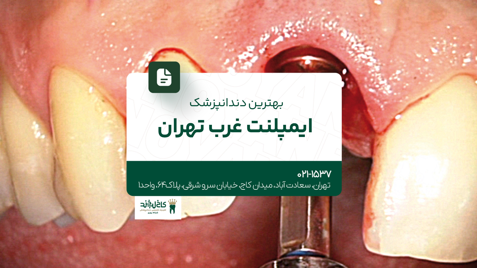 بهترین دندانپزشک ایمپلنت غرب تهران بهترین دندانپزشک ایمپلنت غرب تهران