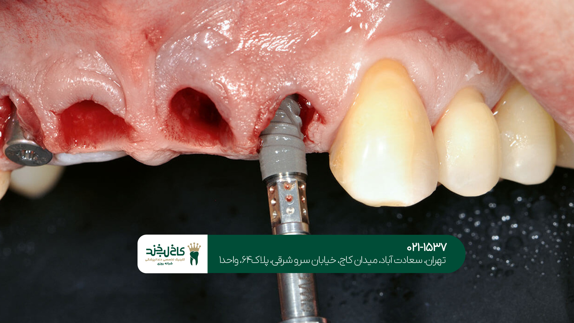 بهترین دندانپزشک ایمپلنت غرب تهران بهترین دندانپزشک ایمپلنت غرب تهران