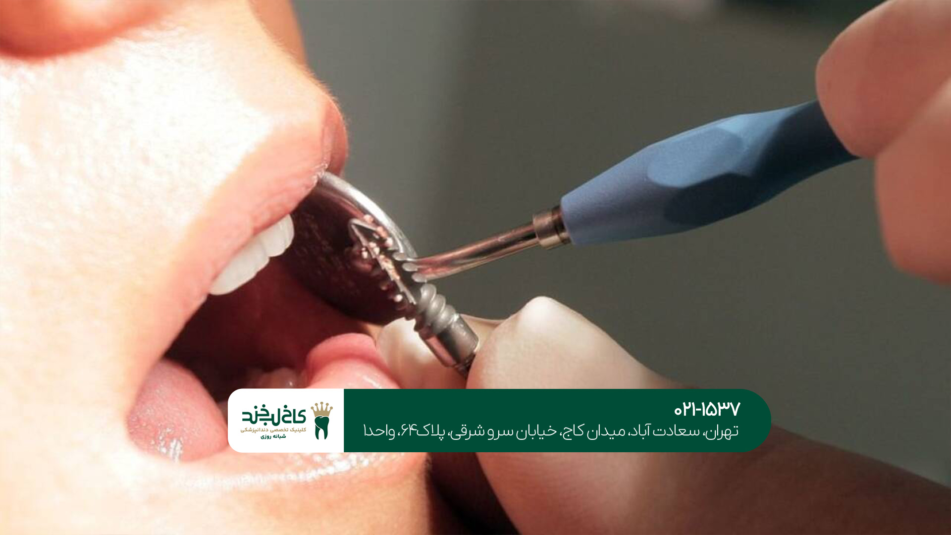 بهترین دندانپزشک ایمپلنت غرب تهران بهترین دندانپزشک ایمپلنت غرب تهران