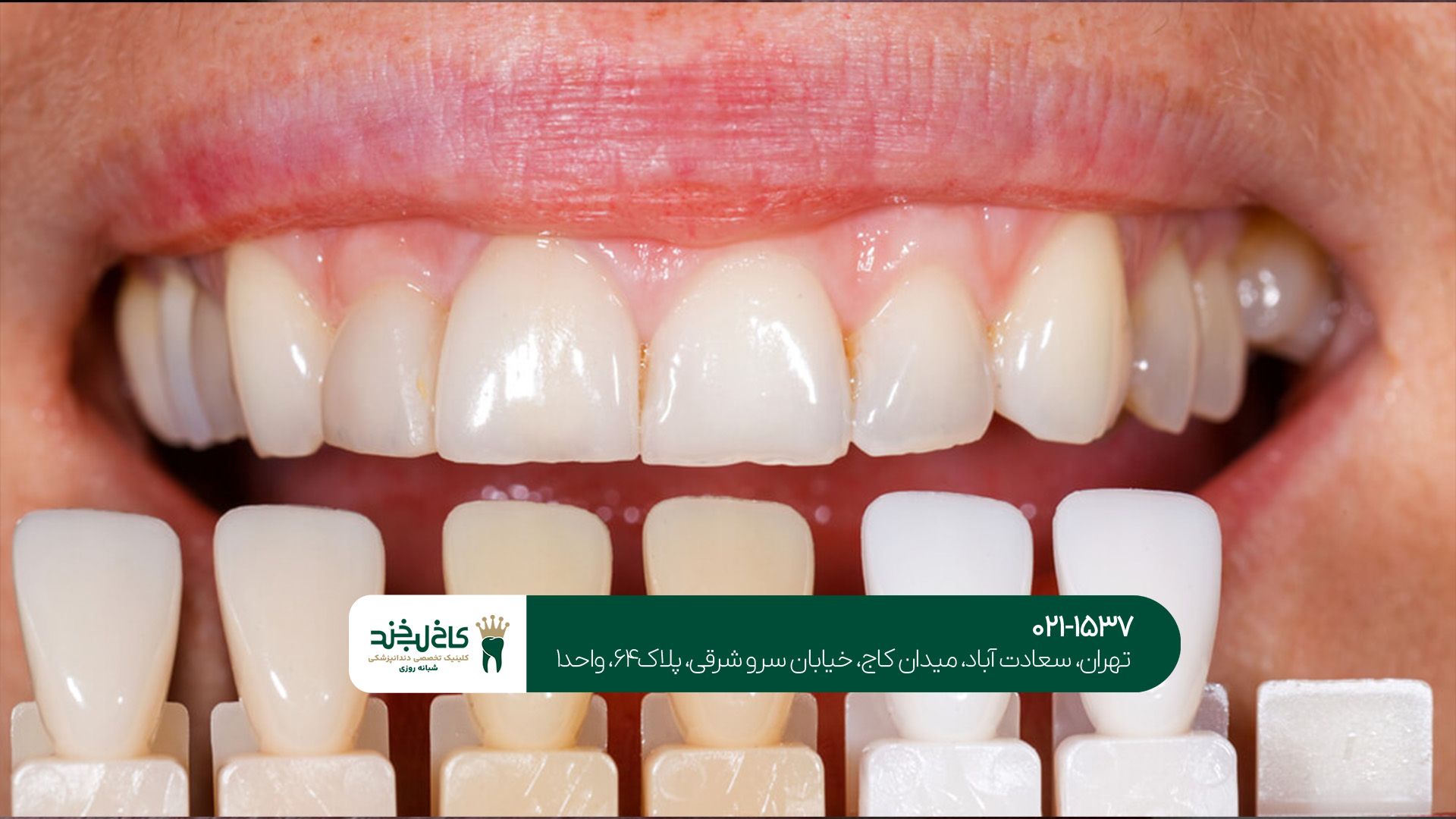 بهترین دندانپزشک کامپوزیت تهران بهترین دندانپزشک کامپوزیت تهران