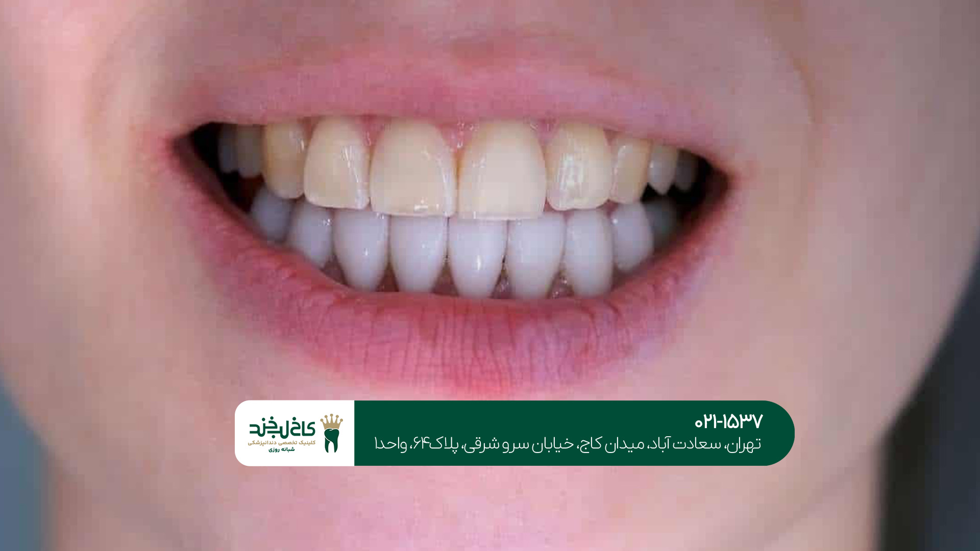 بهترین دندانپزشک کامپوزیت تهران بهترین دندانپزشک کامپوزیت تهران