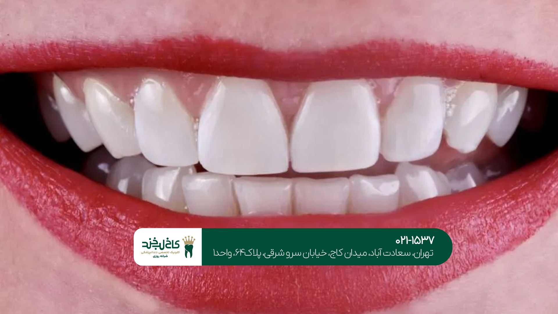 بهترین دندانپزشک کامپوزیت تهران بهترین دندانپزشک کامپوزیت تهران