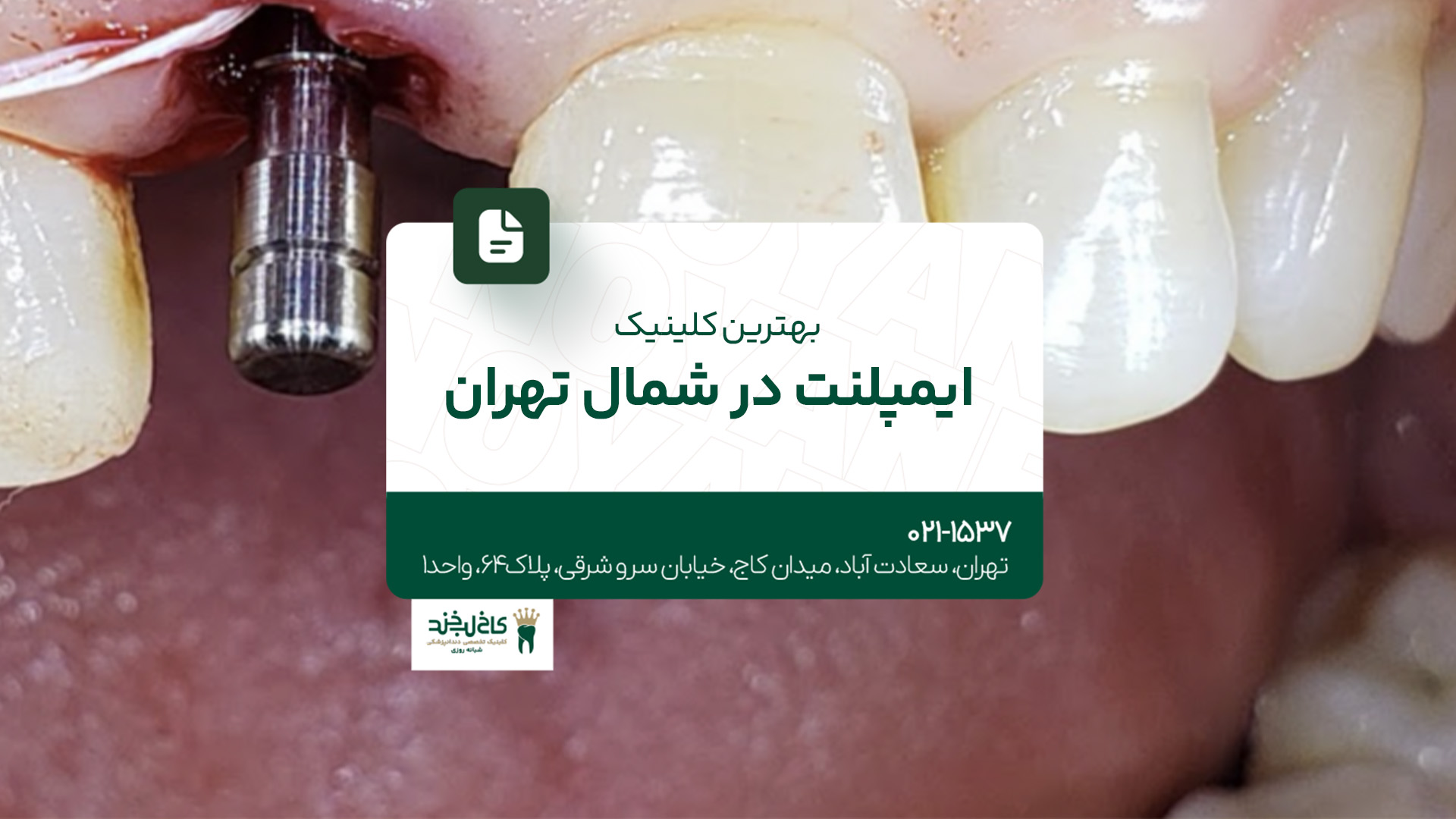 بهترین کلینیک ایمپلنت در شمال تهران