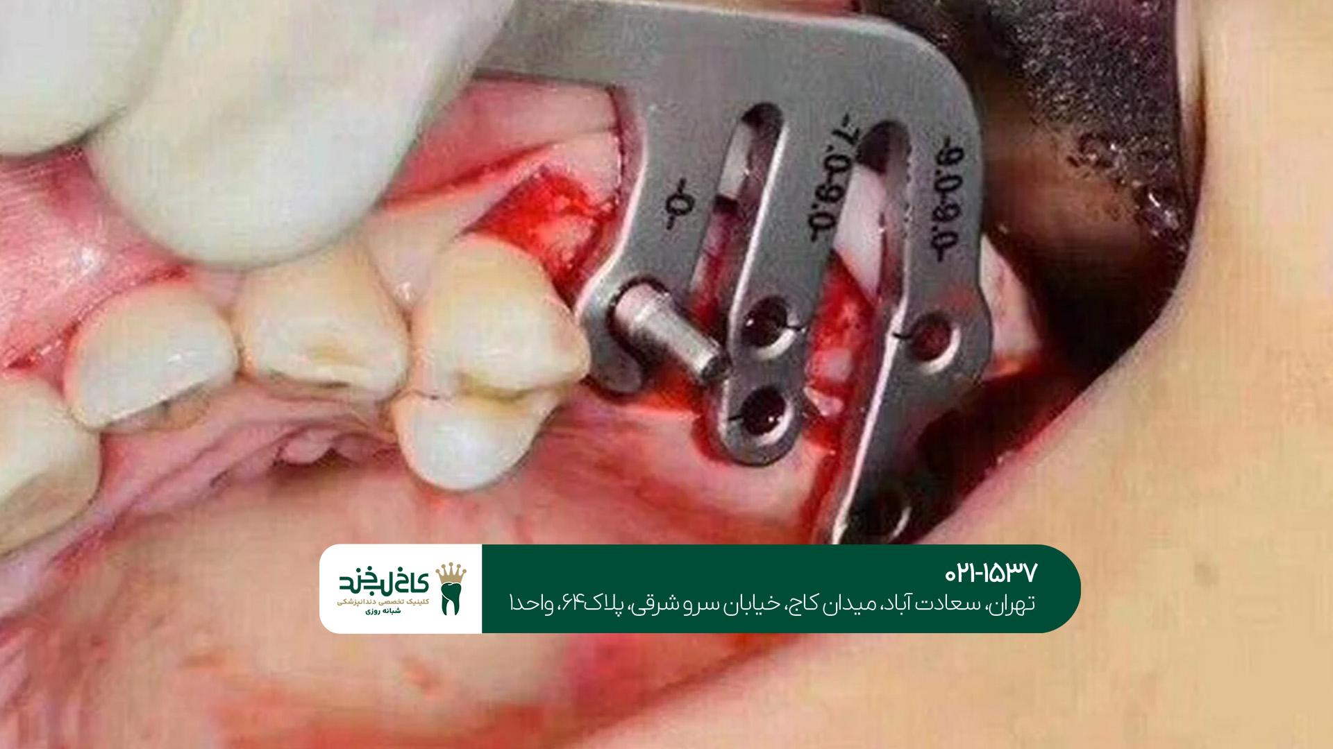 بهترین کلینیک ایمپلنت در شمال تهران