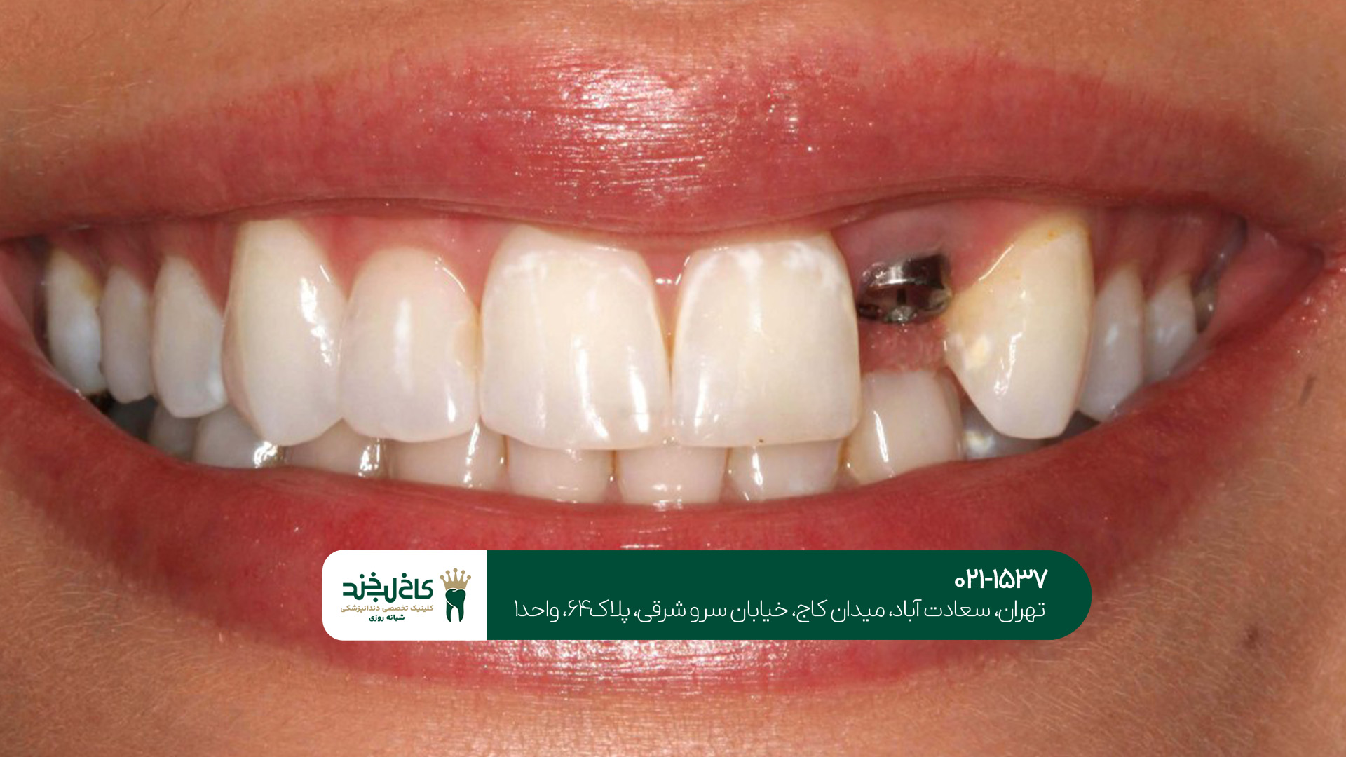 بهترین کلینیک ایمپلنت در شمال تهران