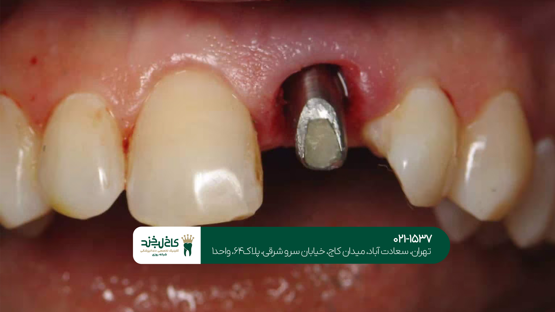 بهترین کلینیک ایمپلنت در شمال تهران