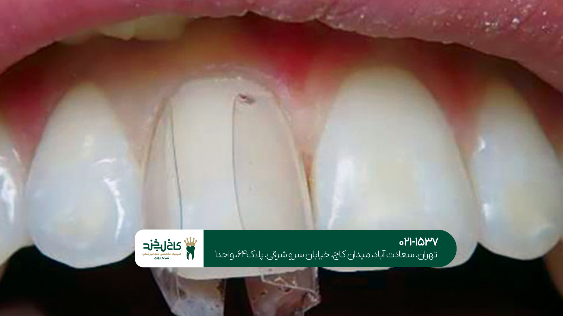 ترمیم دندان شکسته با کامپوزیت ترمیم دندان شکسته با کامپوزیت