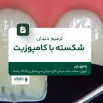 ترمیم دندان شکسته با کامپوزیت