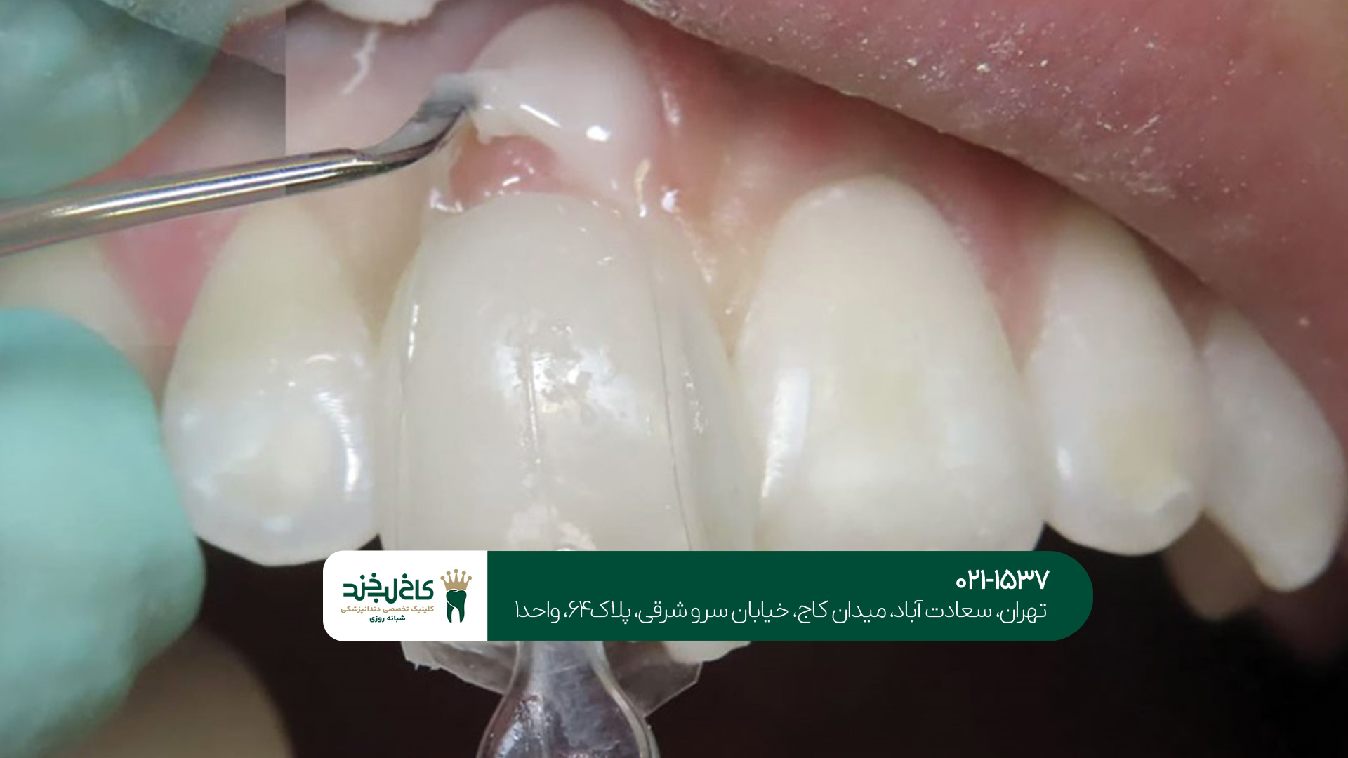 ترمیم دندان شکسته با کامپوزیت ترمیم دندان شکسته با کامپوزیت