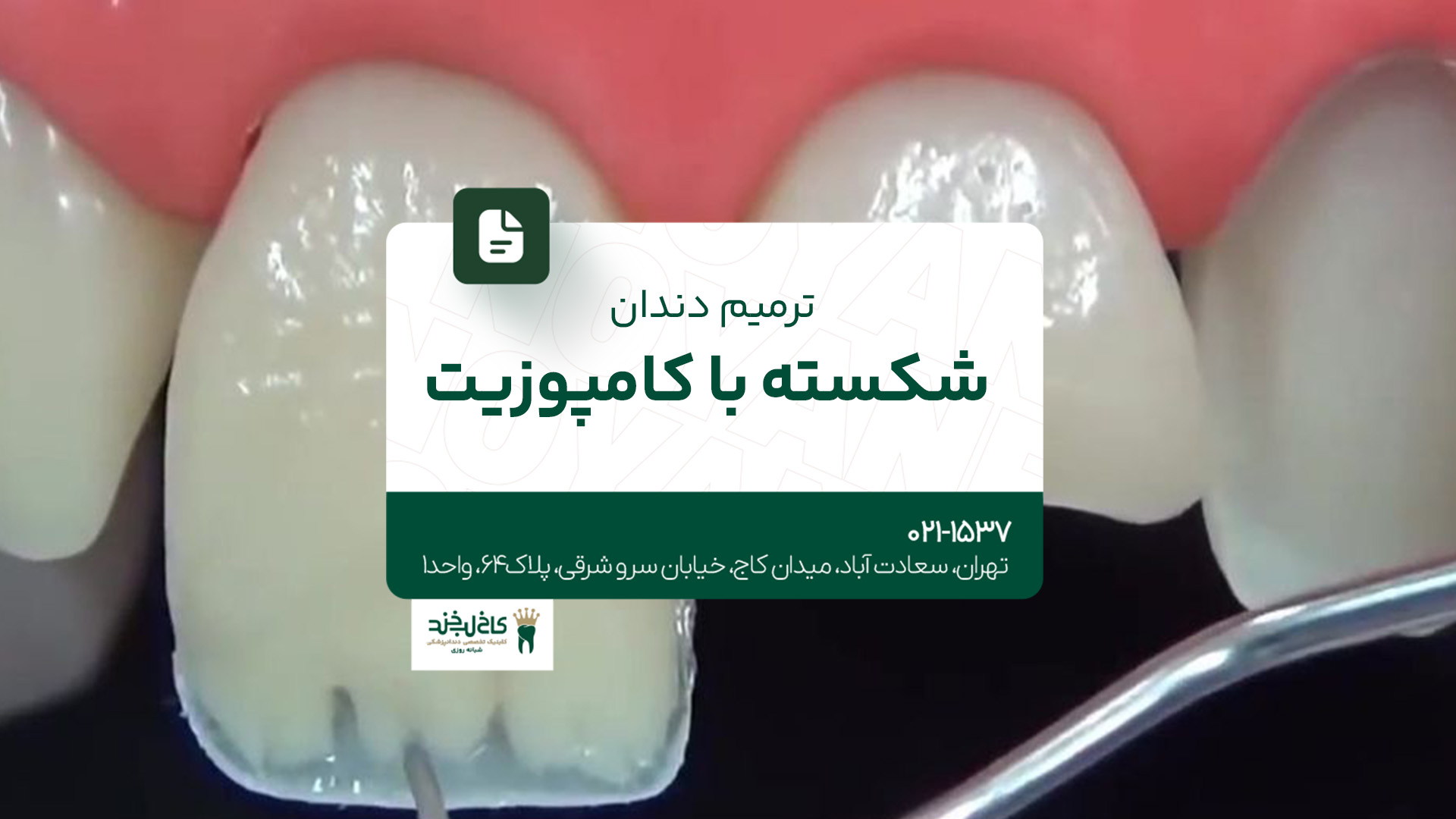 ترمیم دندان شکسته با کامپوزیت ترمیم دندان شکسته با کامپوزیت