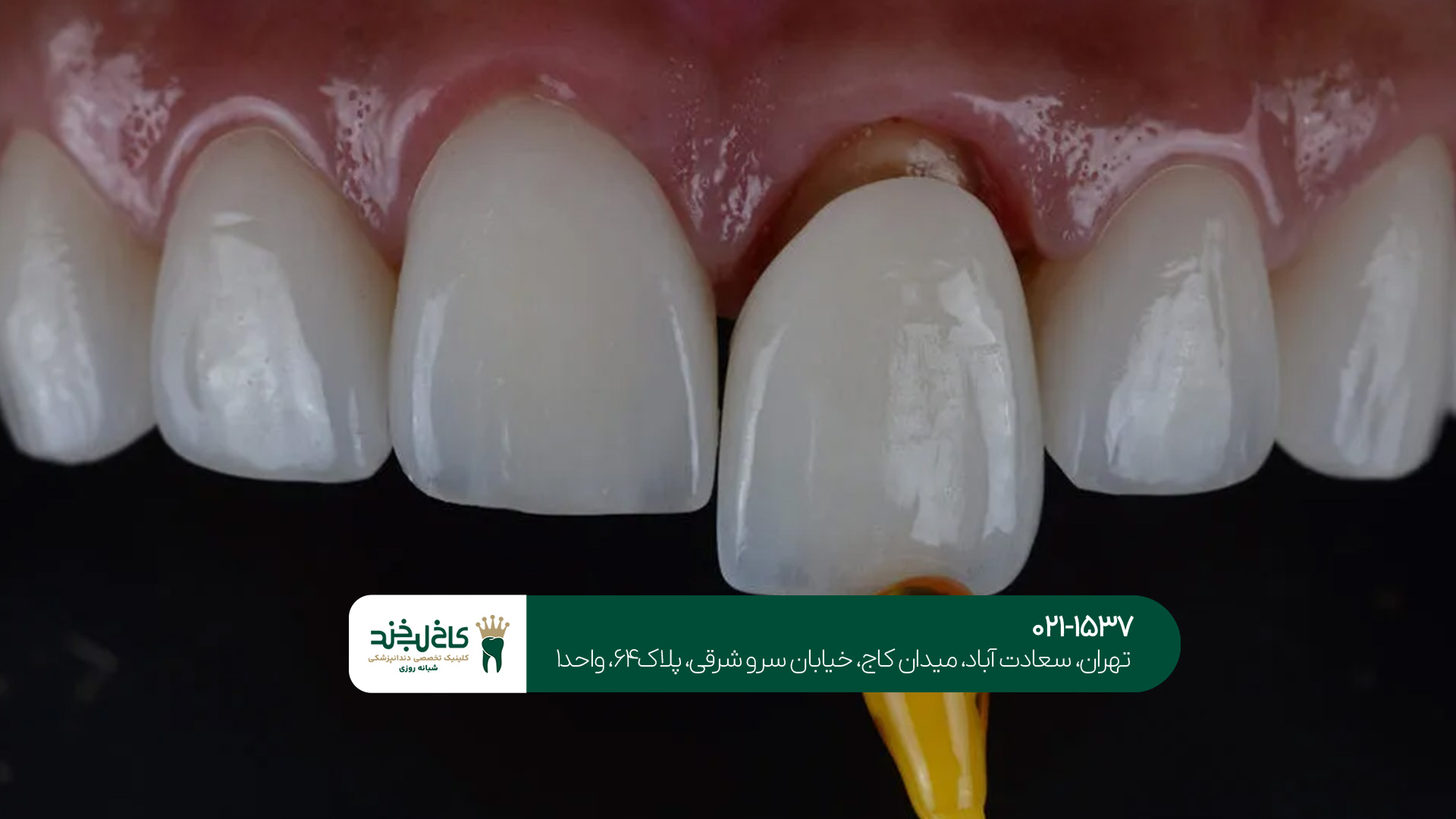 تفاوت روکش زیرکونیا و فلزی تفاوت روکش زیرکونیا و فلزی