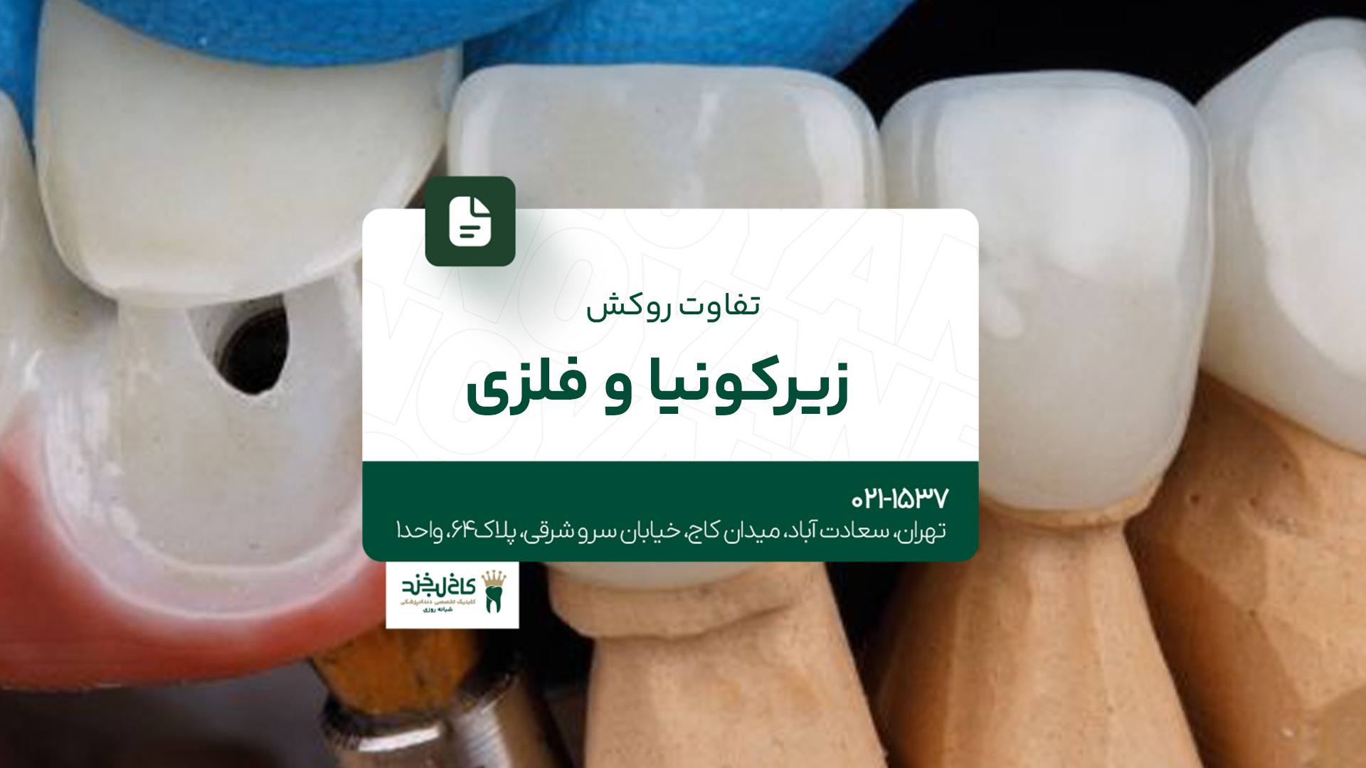 تفاوت روکش زیرکونیا و فلزی تفاوت روکش زیرکونیا و فلزی