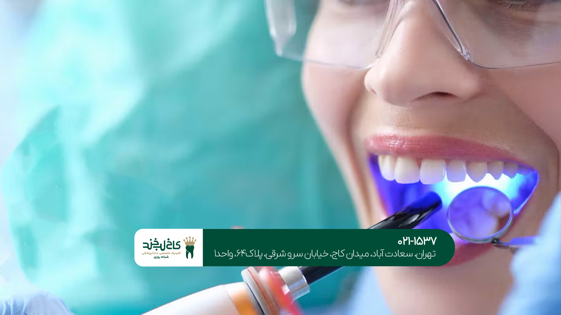 تفاوت لمینت و کامپوزیت دندان