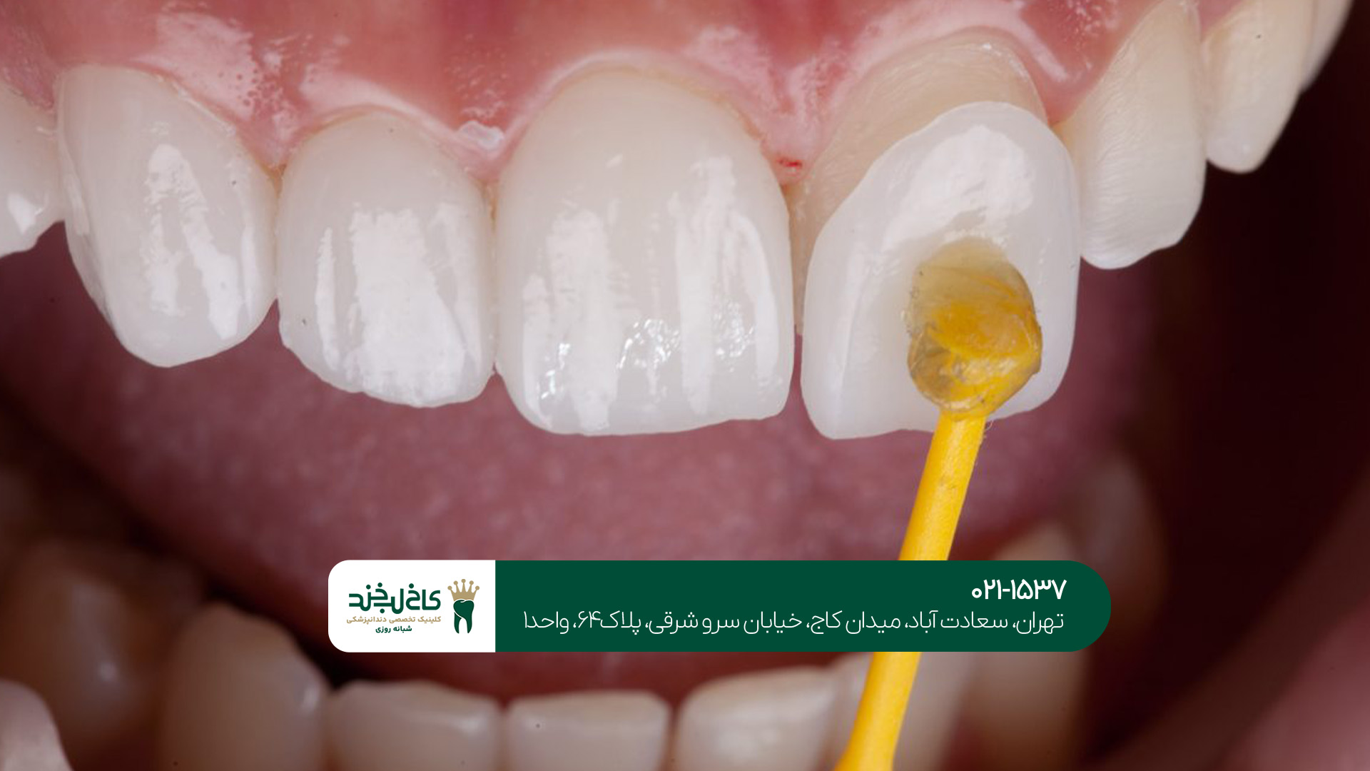 تفاوت لمینت و کامپوزیت دندان