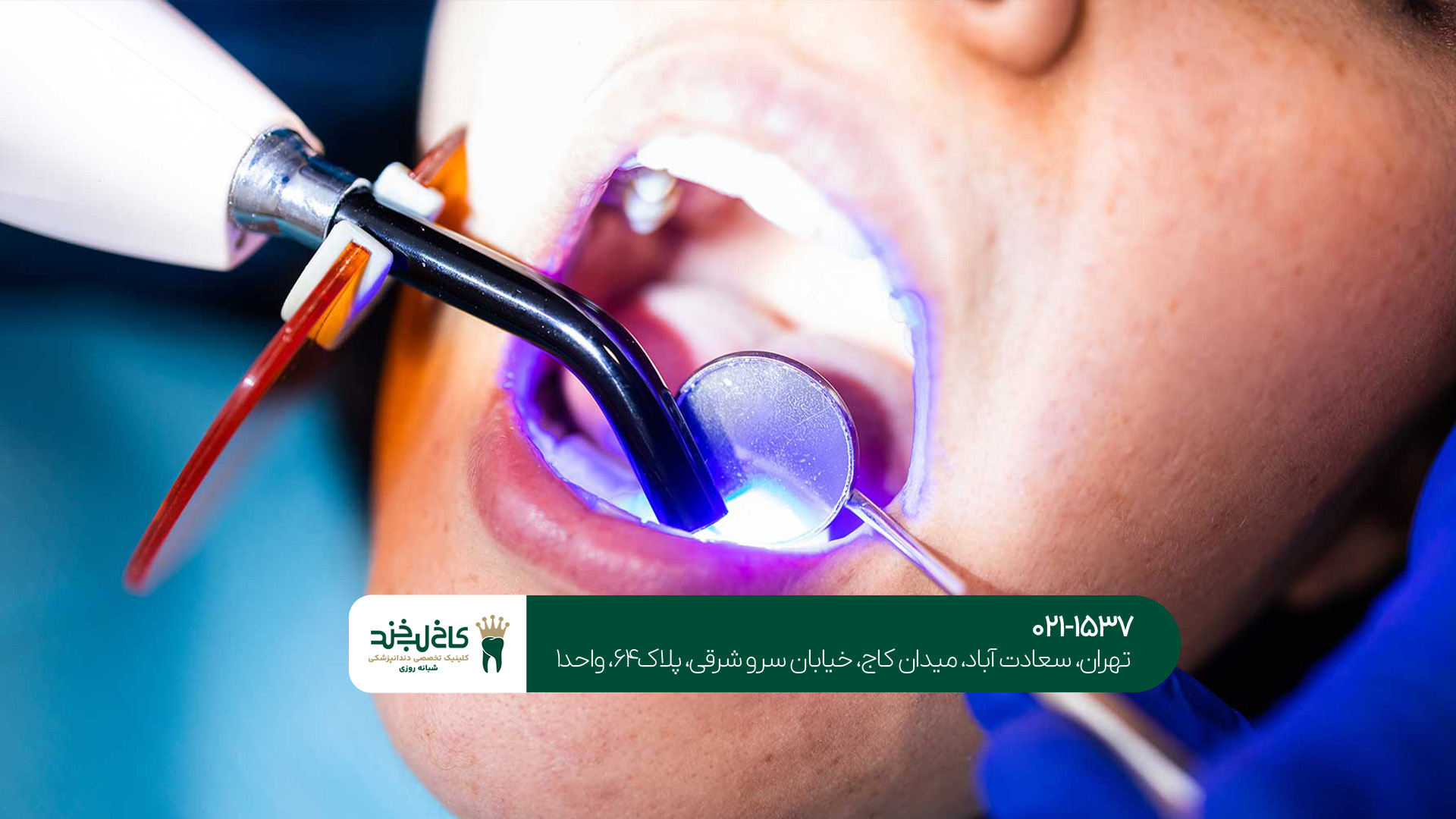 تفاوت لمینت و کامپوزیت دندان