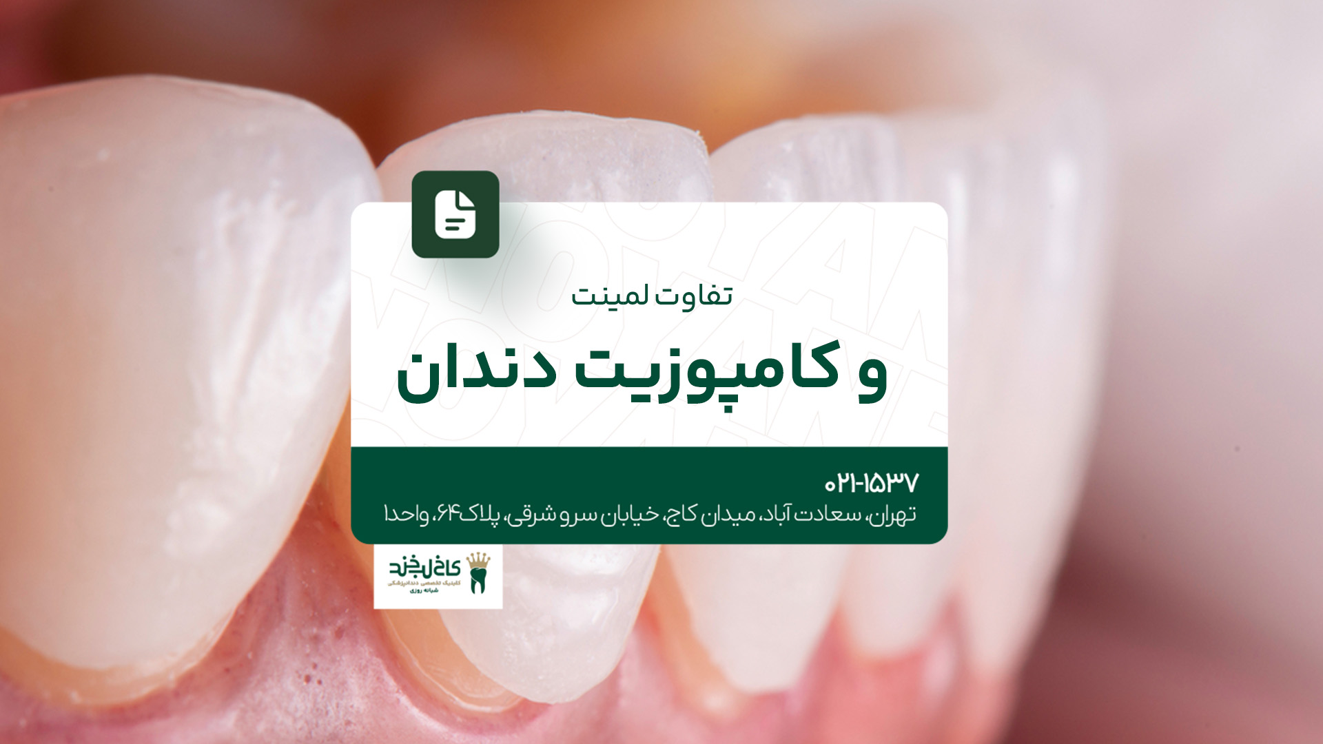 تفاوت لمینت و کامپوزیت دندان