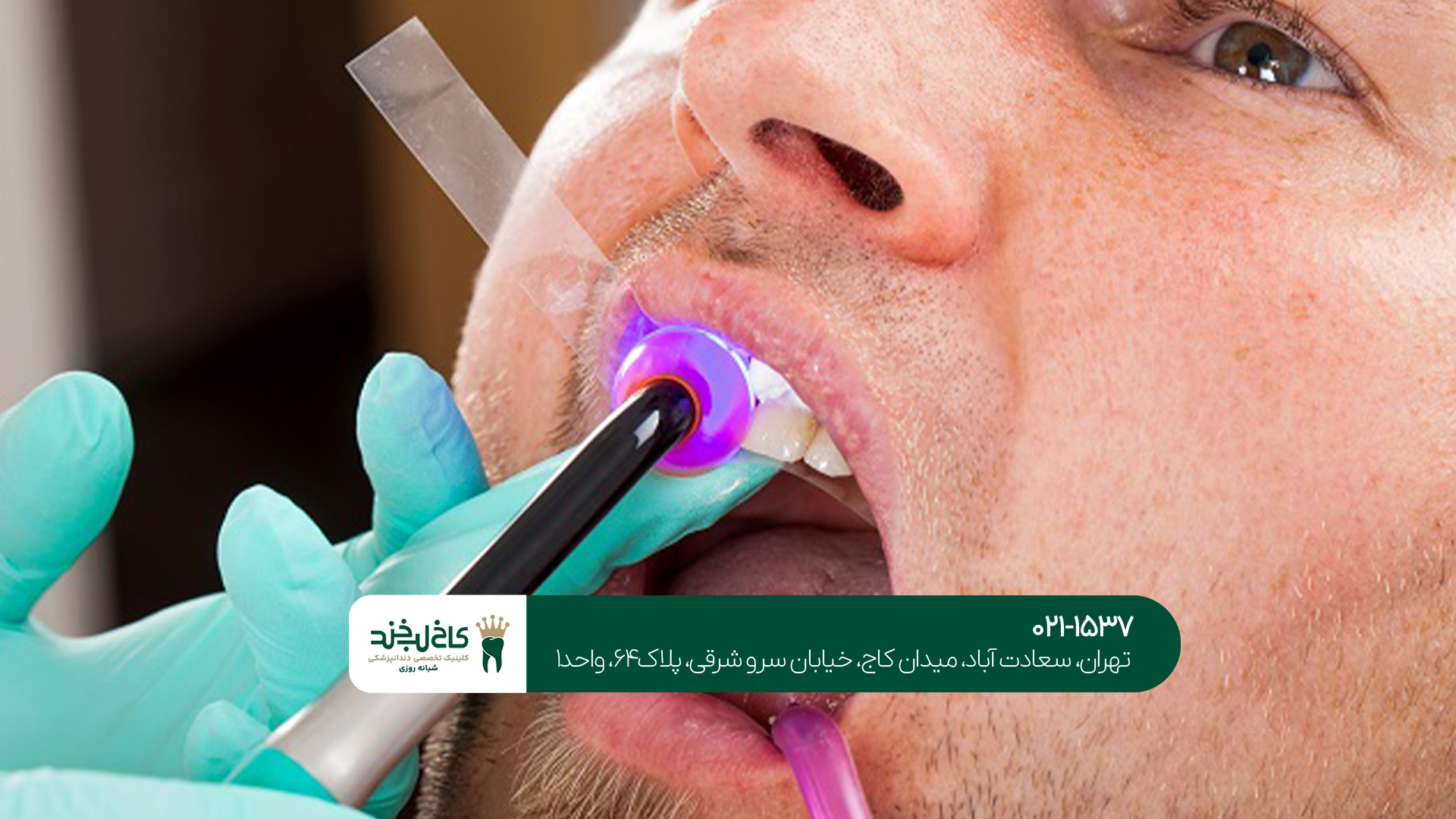 تفاوت لمینت و کامپوزیت چیست؟