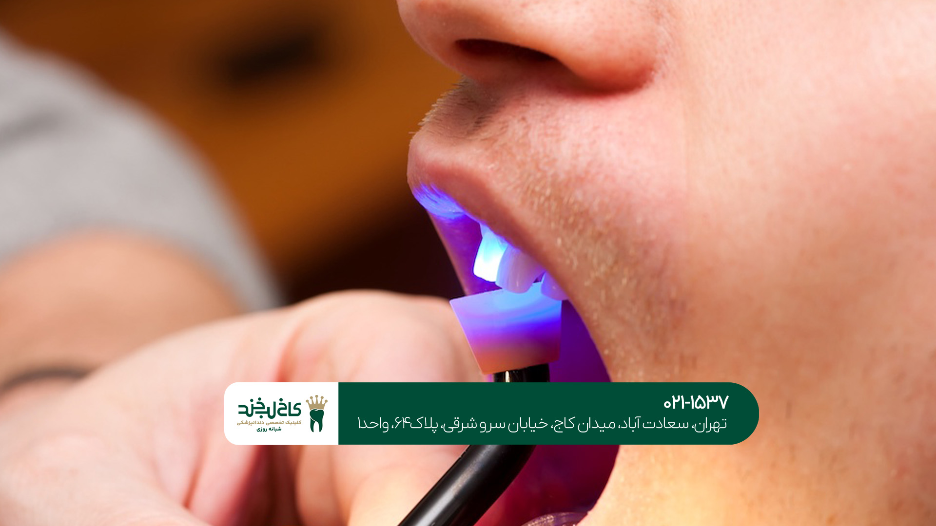 تفاوت لمینت و کامپوزیت چیست؟