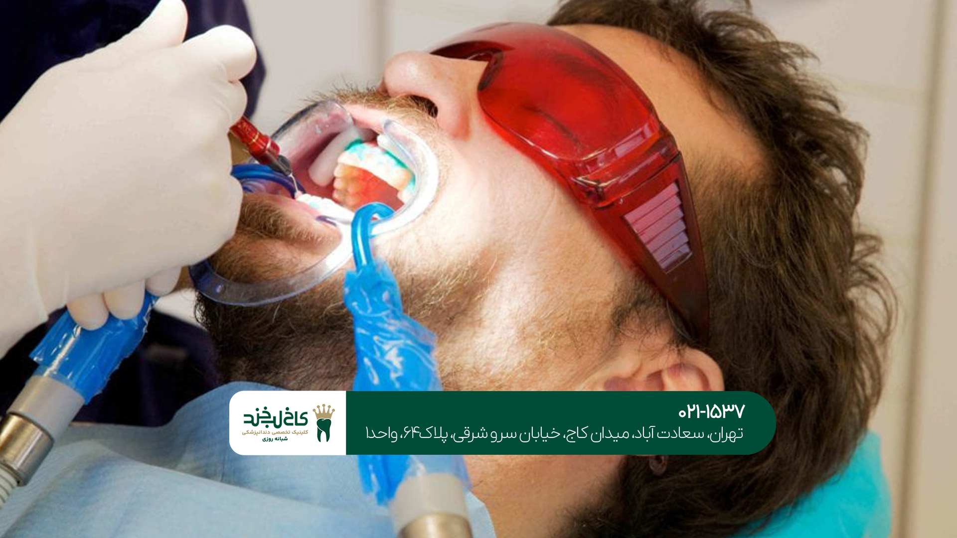 جدیدترین روش های سفید کردن دندان جدیدترین روش های سفید کردن دندان