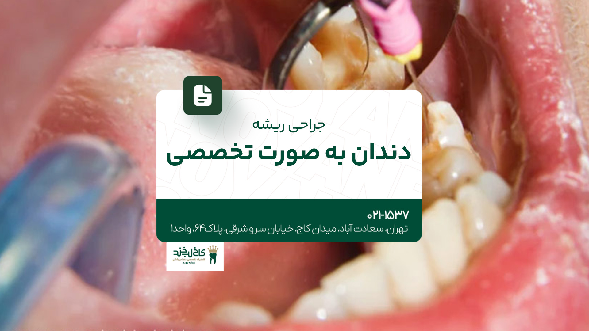 جراحی ریشه دندان به صورت تخصصی جراحی ریشه دندان به صورت تخصصی