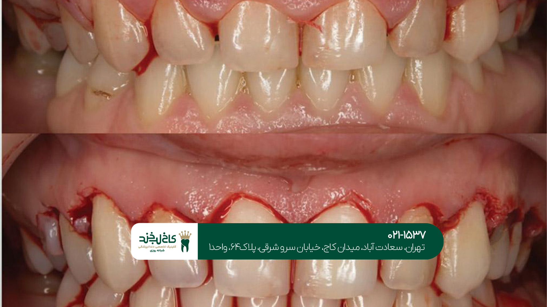 جراحی لثه جراحی لثه