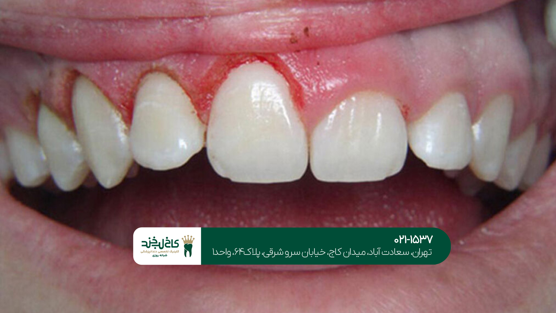 جراحی لثه در تهران جراحی لثه در تهران