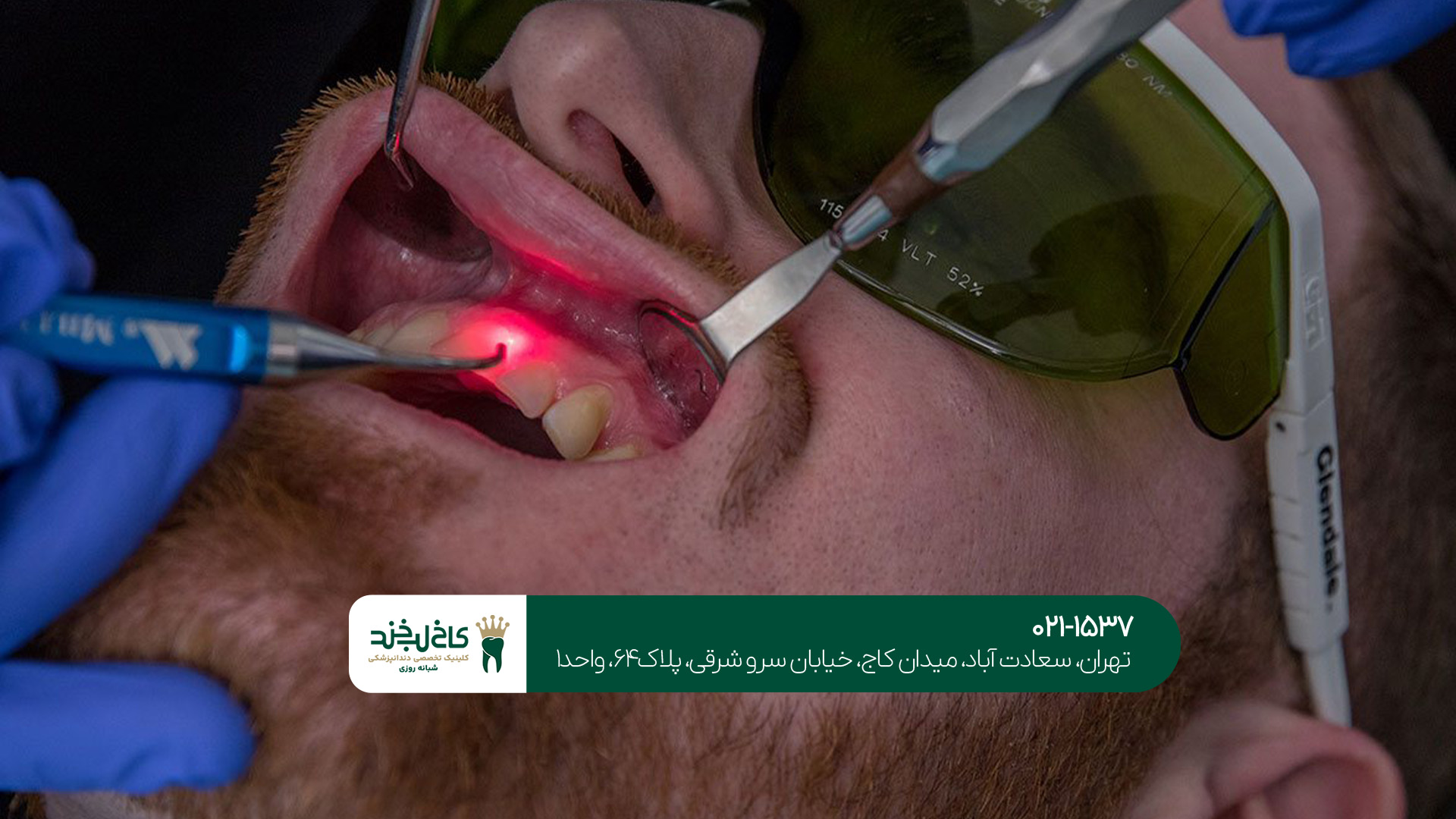 جراحی لثه به صورت لیزری