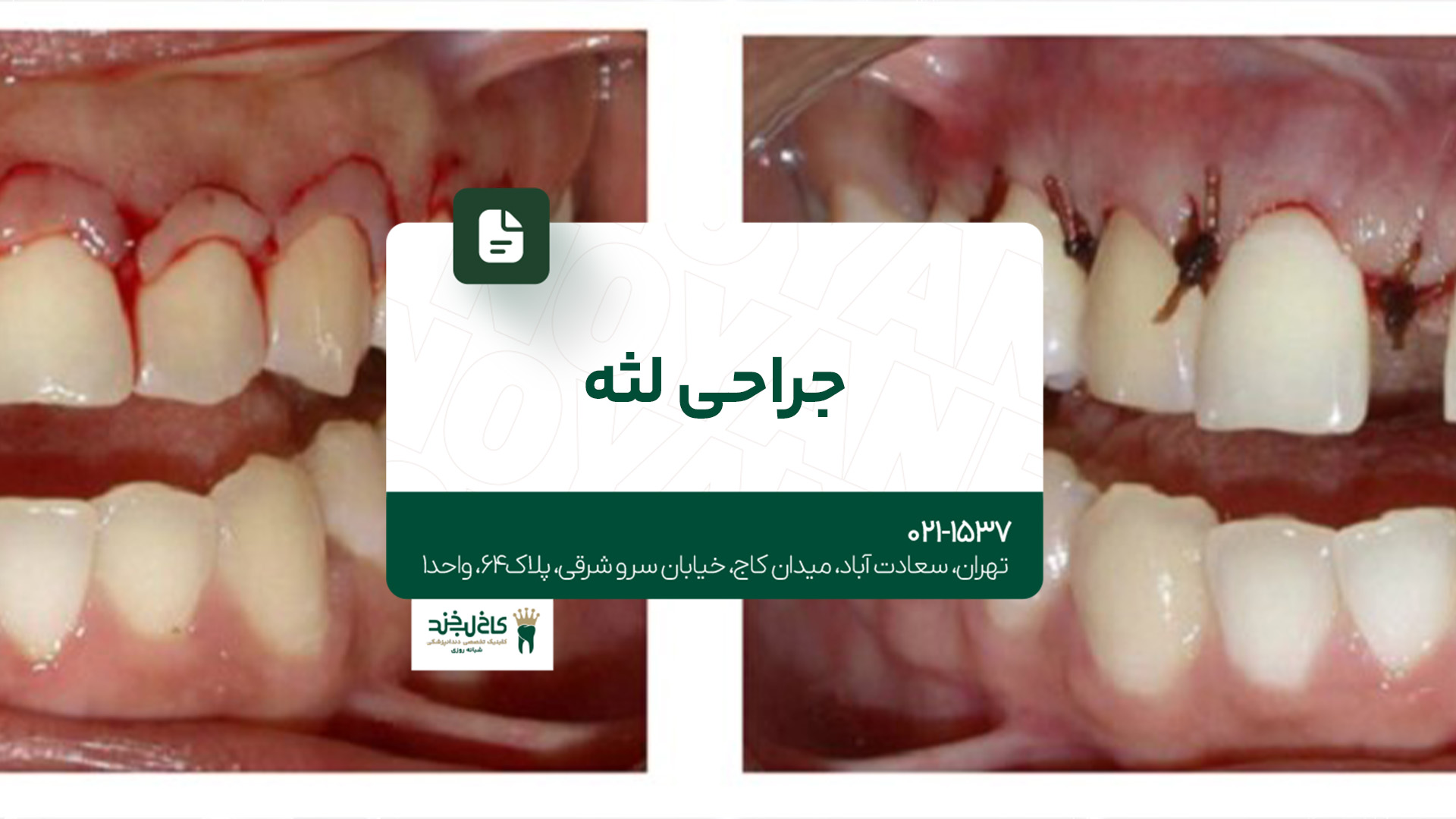 جراحی لثه جراحی لثه