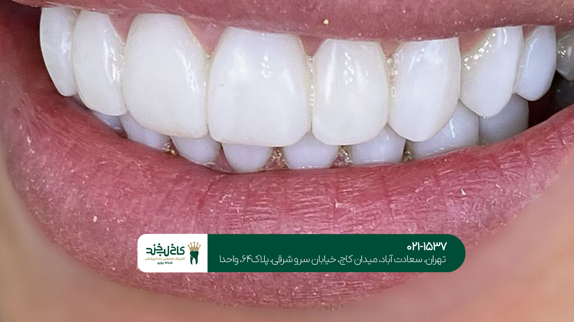 خدمات ترمیم و روکش دیجیتال دندان