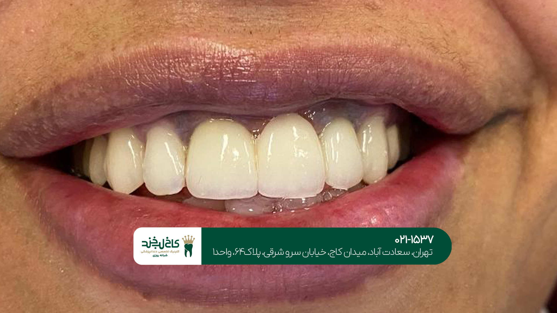 خدمات ترمیم و روکش دیجیتال دندان