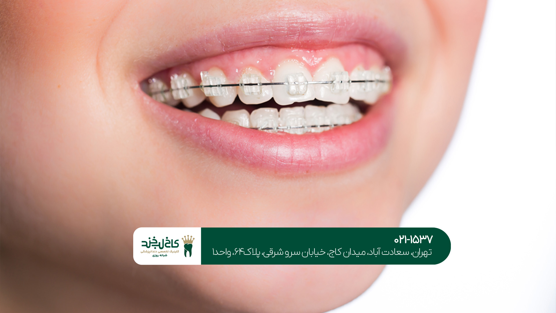 بهترین سن برای شروع ارتودنسی بهترین سن برای شروع ارتودنسی