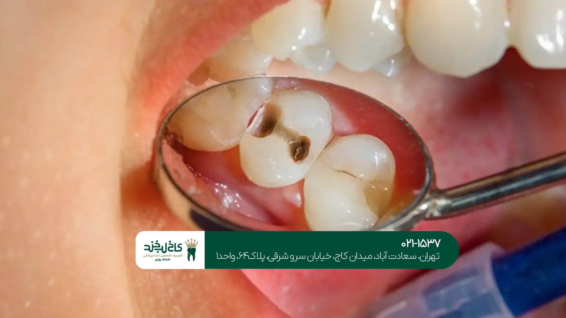 حساس شدن دندان بعد از ترمیم حساس شدن دندان بعد از ترمیم