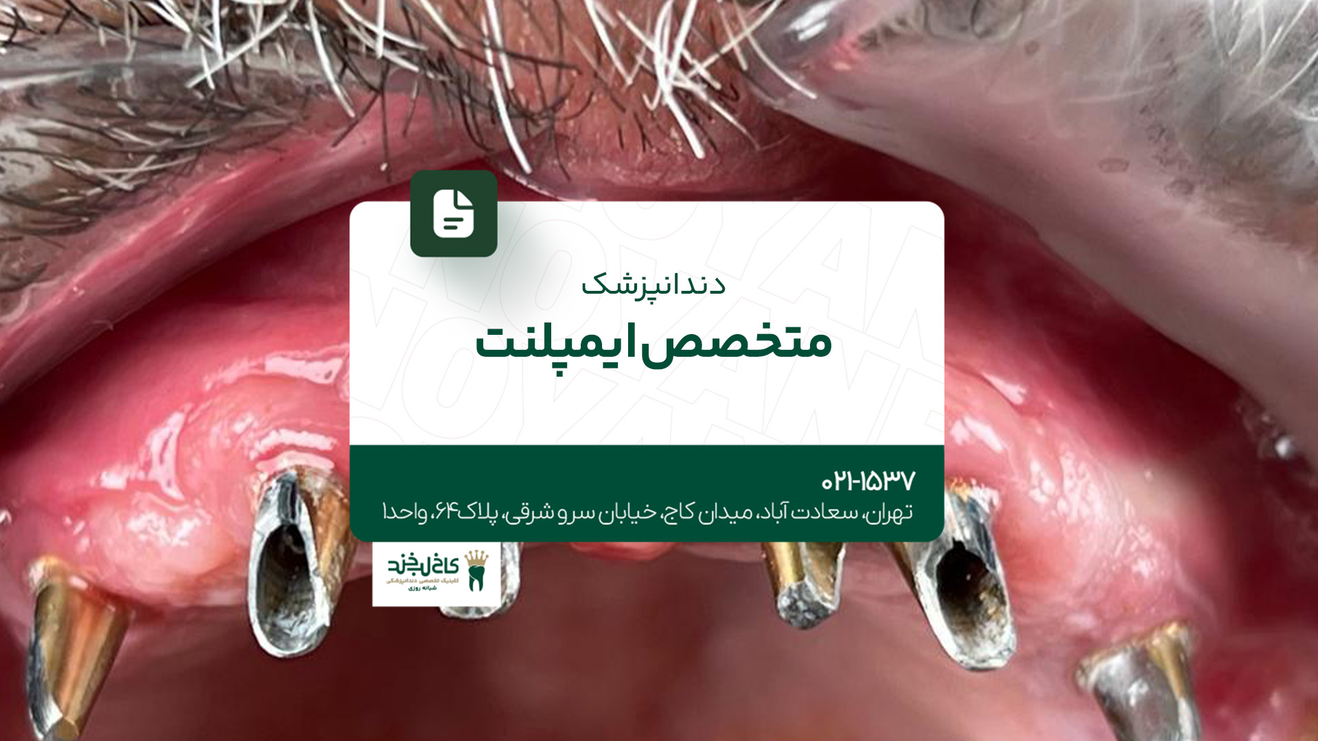 دندانپزشک متخصص ایمپلنت دندانپزشک متخصص ایمپلنت