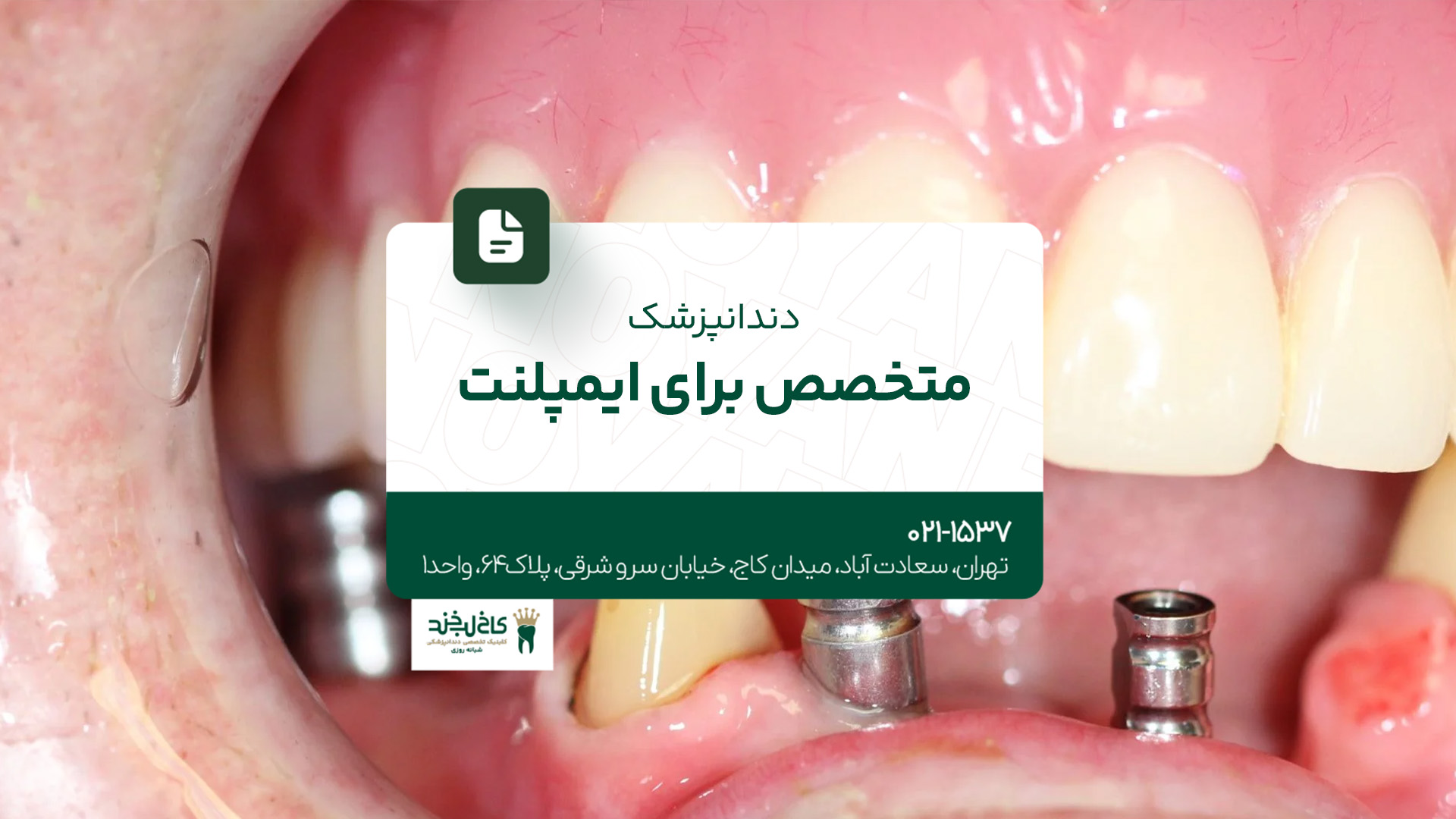 دندانپزشک متخصص برای ایمپلنت دندانپزشک متخصص برای ایمپلنت