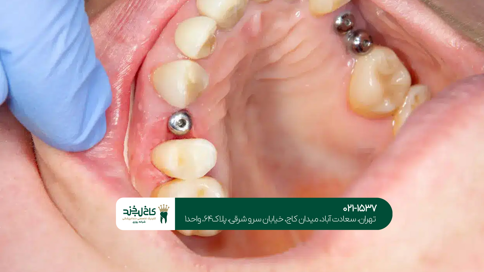 دندانپزشک متخصص ایمپلنت غرب تهران دندانپزشک متخصص ایمپلنت غرب تهران