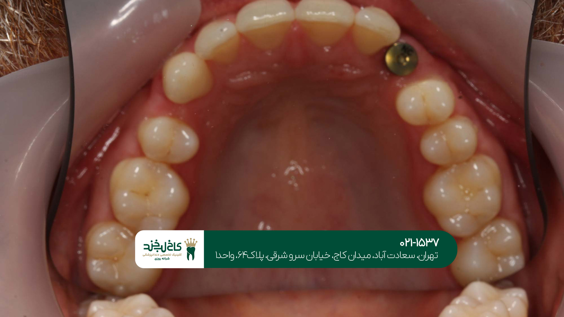دندانپزشک متخصص ایمپلنت غرب تهران دندانپزشک متخصص ایمپلنت غرب تهران