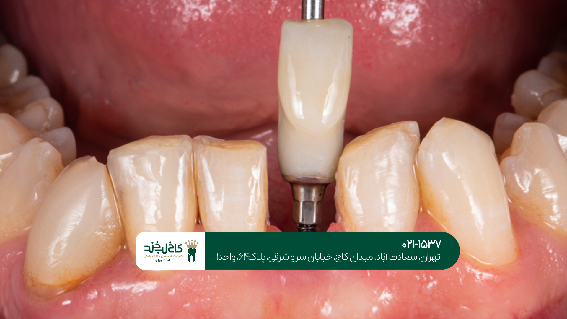دندانپزشک متخصص ایمپلنت غرب تهران دندانپزشک متخصص ایمپلنت غرب تهران