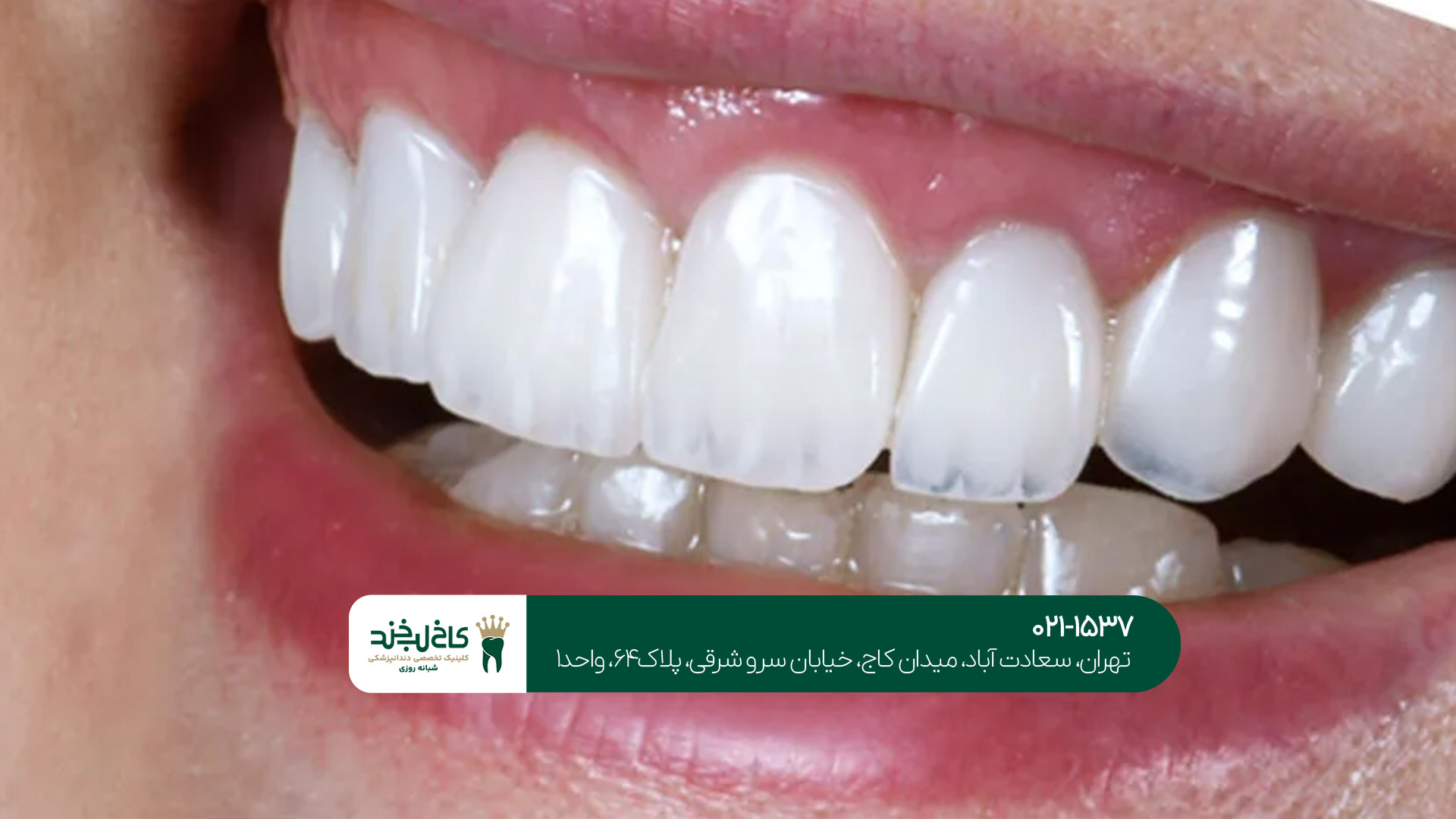 دندانپزشک متخصص لمینت و کامپوزیت