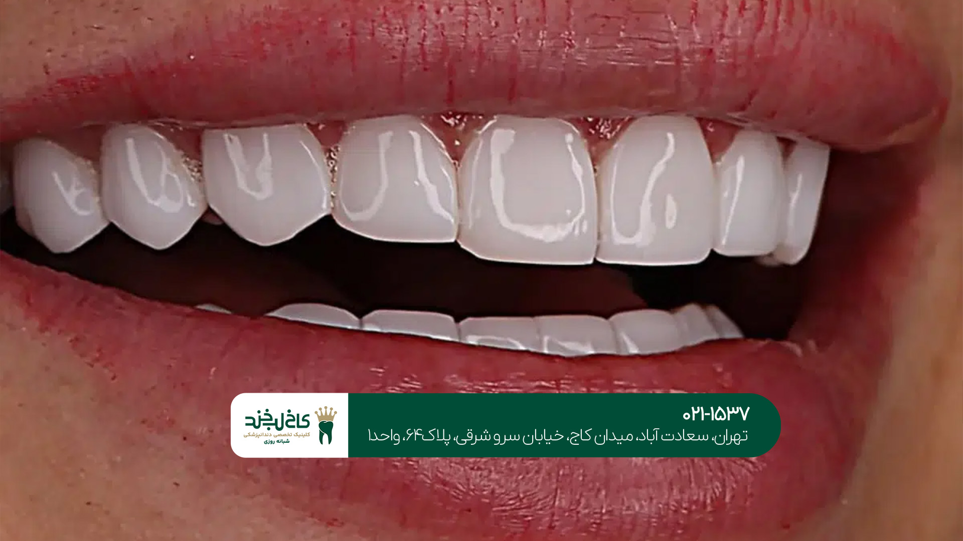 دندانپزشک متخصص لمینت و کامپوزیت