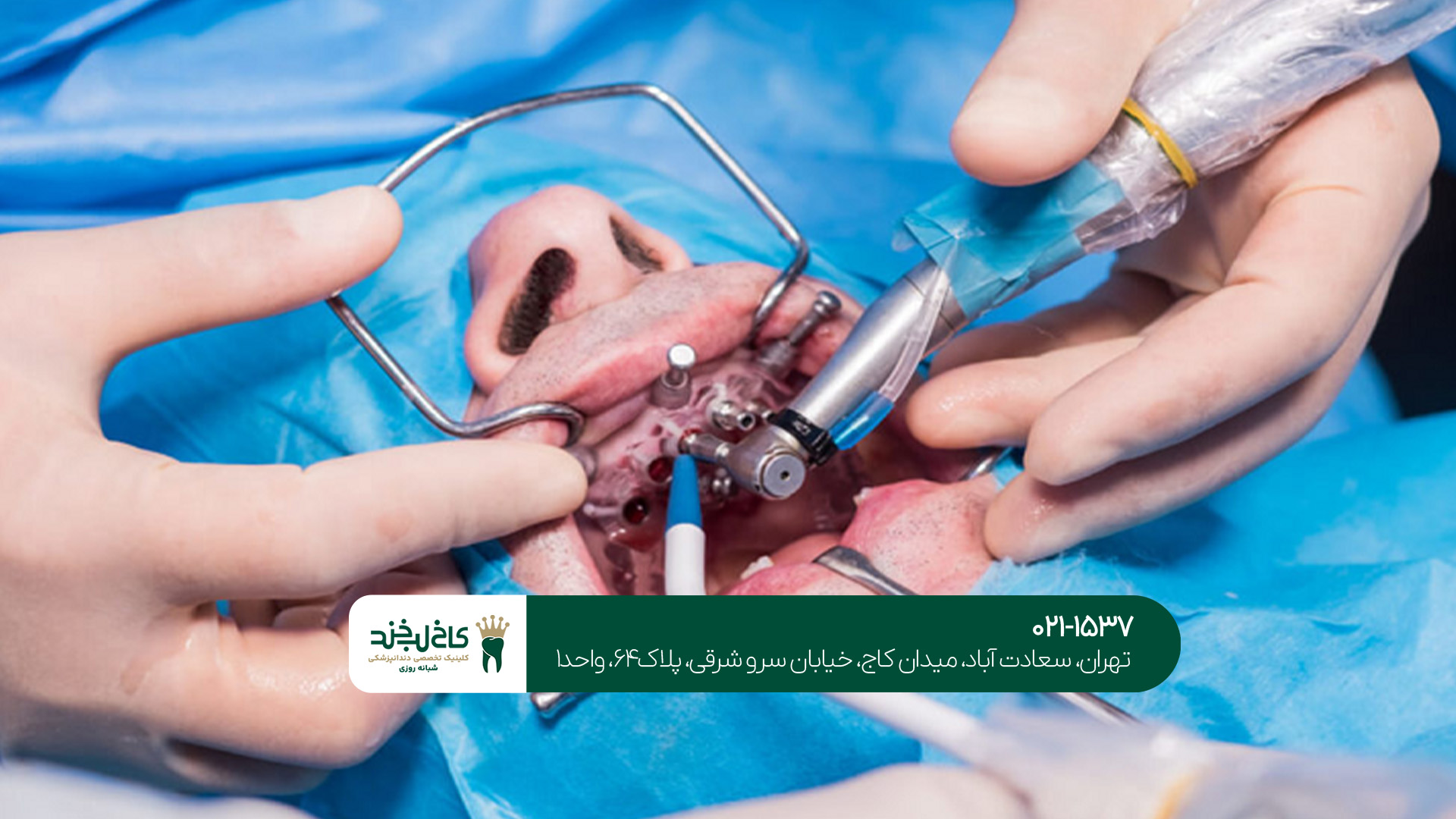 ایمپلنت یک روزه در غرب تهران