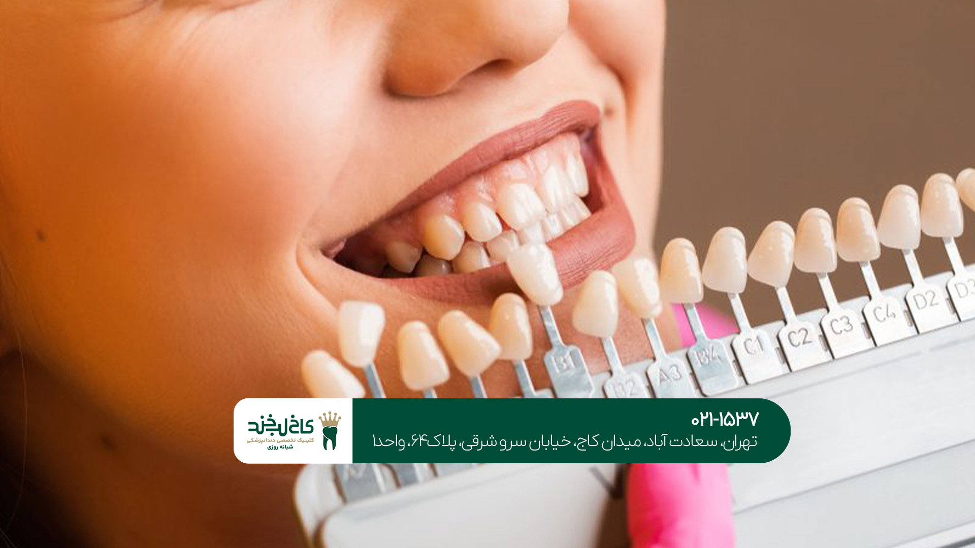 دندانپزشکی تخصصی لمینت و کامپوزیت در تهران