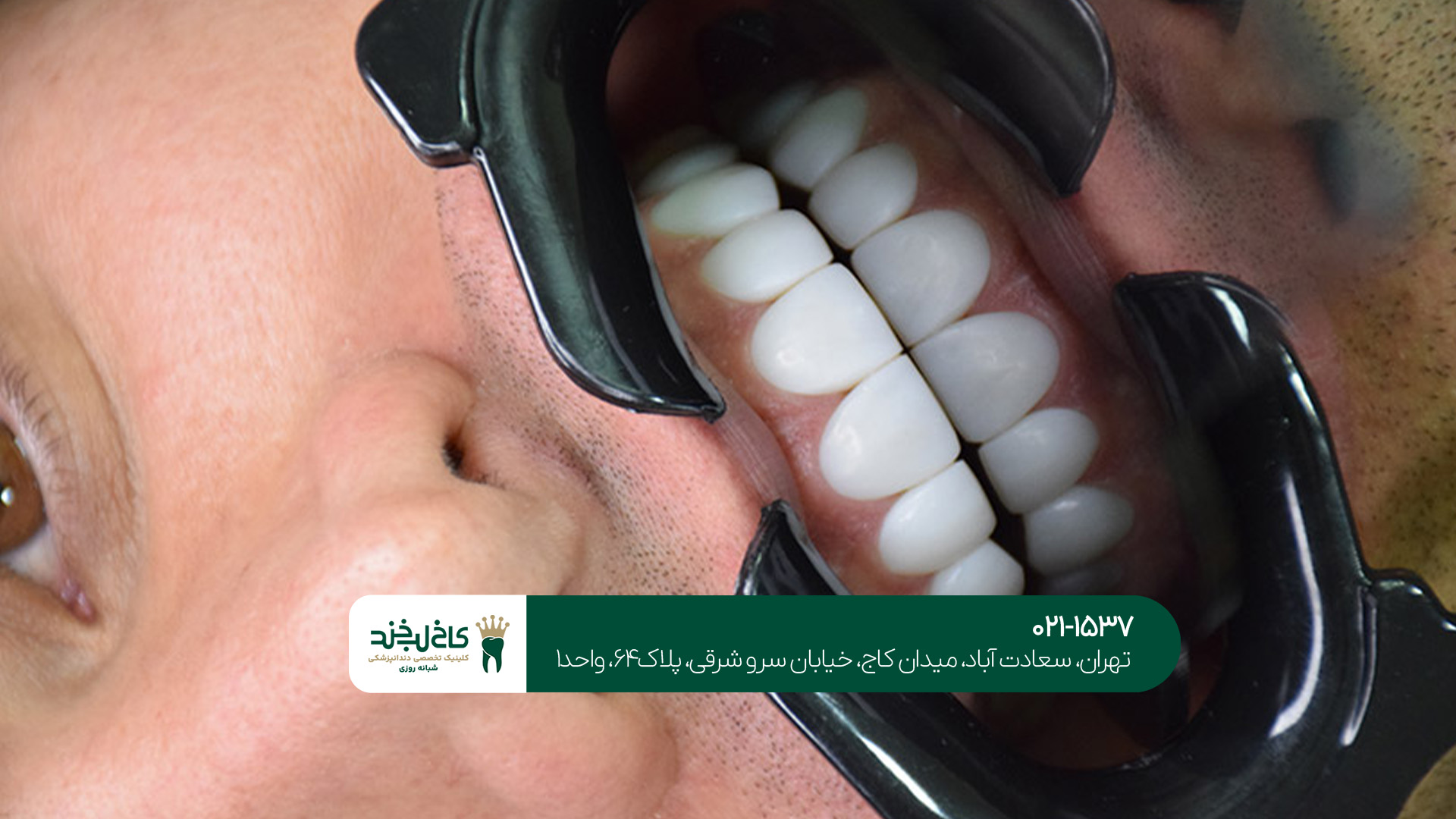 روکش دندان دیجیتال روکش دندان دیجیتال