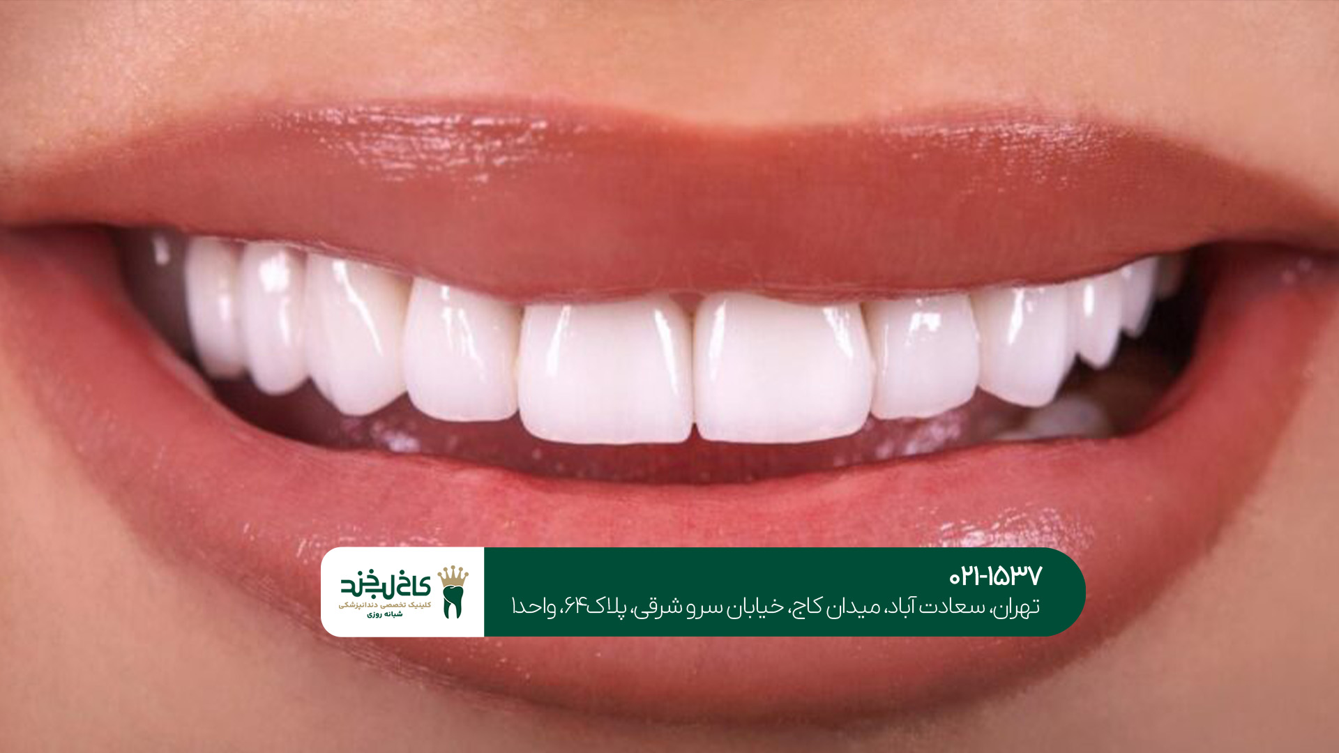 روکش دندان دیجیتال روکش دندان دیجیتال