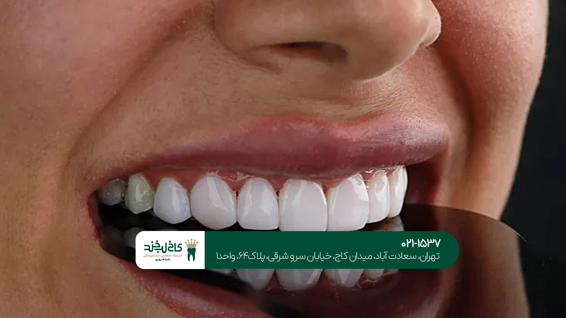 روکش دندان دیجیتال روکش دندان دیجیتال