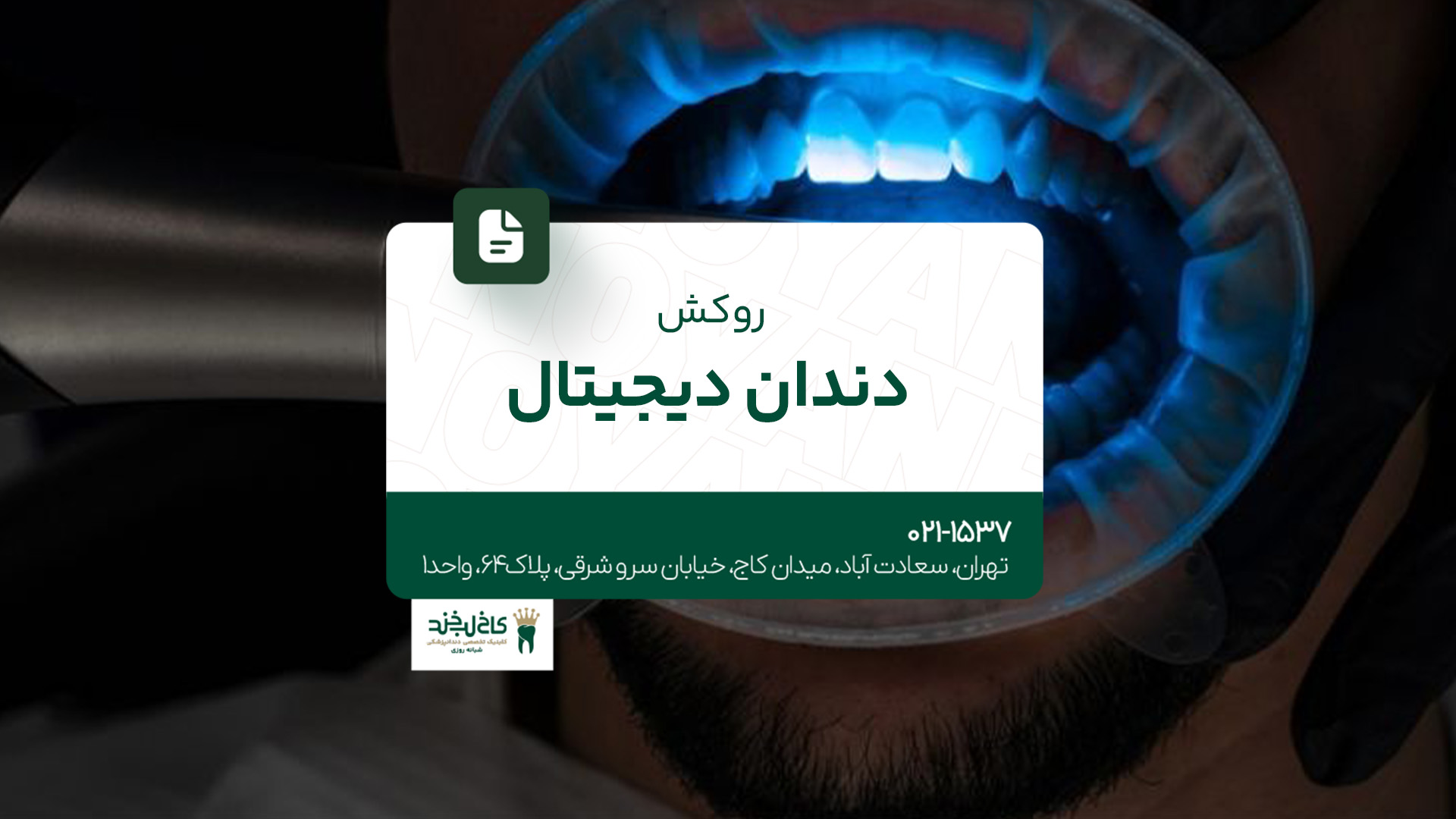 روکش دندان دیجیتال روکش دندان دیجیتال