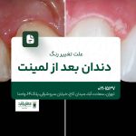 علت تغییر رنگ دندان بعد از لمینت