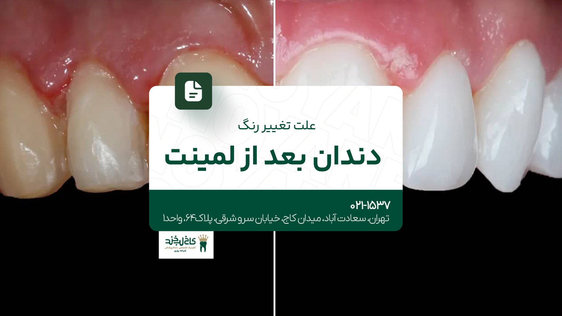 علت تغییر رنگ دندان بعد از لمینت علت تغییر رنگ دندان بعد از لمینت