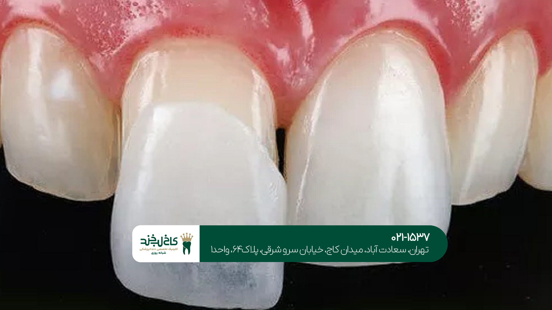 تغییر رنگ دندان بعد از لمینت تغییر رنگ دندان بعد از لمینت